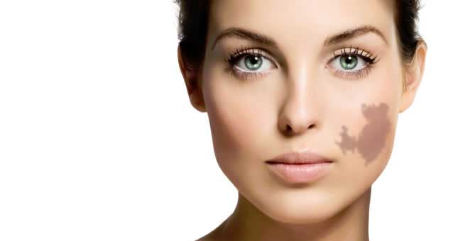 Non-Surgical Birthmark Removal Techniques in Kolkata