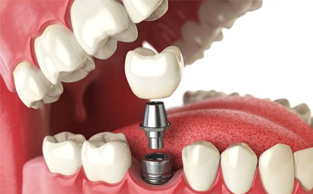 Choosing the Best Dental Implants Clinic in Kolkata for Your Needs